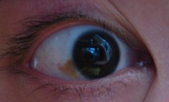 眼睛白眼球上有黄斑怎么办？注重眼睛的健康很重要！