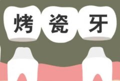 烤瓷牙矫正怎么样？烤瓷牙矫正多了解帮助牙齿变整齐！