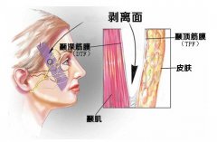 内窥镜面部提升手术结果怎么样？内窥镜面部提升手术怎么样？