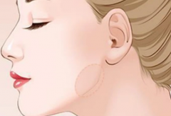 轮廓固定就是填充吗？轮廓固定是什么医美项目？