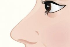 鼻孔外翻怎么办？手术方法改善鼻孔外翻是很好的！