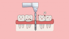 补牙多少钱一颗2022价格表怎么样？影响补牙的因素有哪些？