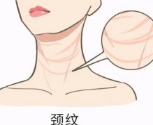 瑞兰除皱怎么样？瑞兰玻尿酸除皱注意事项有哪些？