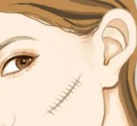 微粒皮移植有疤痕吗？内有注意事项和疤痕去除有哪些方法