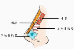 自体软骨隆鼻有什么优缺点？自体软骨隆鼻的注意事项有哪些？