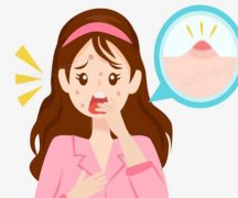 广州医科大学附属第二医院祛痘印怎么样？多少钱？
