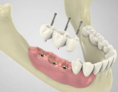 种植牙多少钱一颗？价格表情况怎么样？