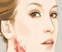 中山博爱医院去疤痕多少钱？