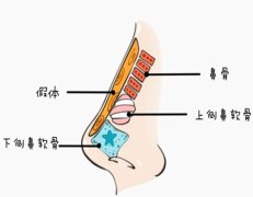 上海九院做假体隆鼻要多少钱？