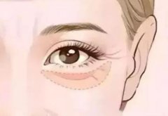 上海九院眼袋手术怎么样？