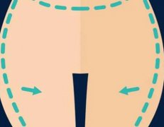 臀部吸脂价格贵吗？