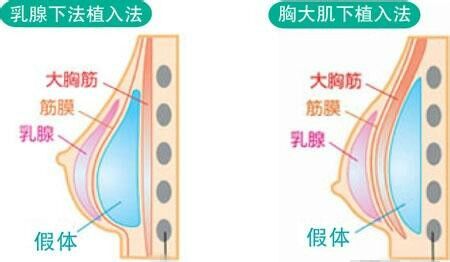 北京八大处整形医疗美容医院隆胸案例