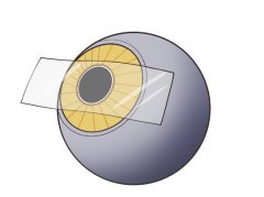 evoicl晶体植入术优缺点是什么？查看优缺点一览啦