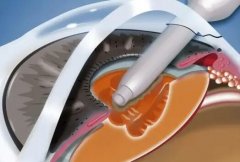 ICL晶体植入的位置在哪？查看详细科普介绍一览