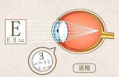 做散光手术一般多少钱？做散​光手术怎么选择