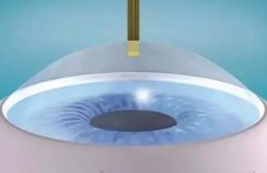 角膜屈光手术有哪些方法？注意事项和术前检查必了解