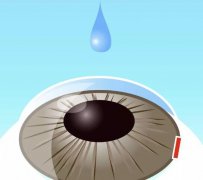 天津icl晶体植入多少钱？看看优点有哪些？