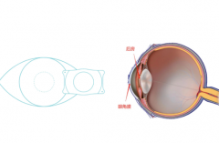 icl人工晶体植入危害是什么？看看危害有哪些