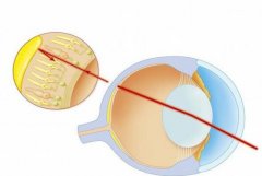 圆锥角膜移植效果好吗？赶紧来看看科普资料详情吧