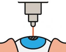 屈光度是近视度数吗？了解正常范围是多少