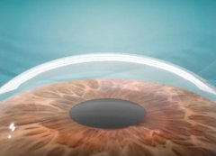 近视激光手术有什么作用？近视激光手术有什么后遗症吗