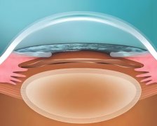 EVO Toric ICL散光矫正效果怎么样？优缺点戳进来分析