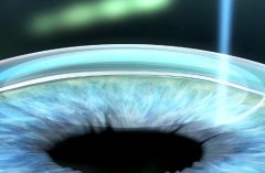 三种近视手术的优缺点都有什么？速看优缺点一览