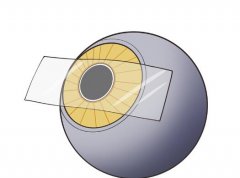 晶体植入icl加不加散光区别大吗？看看详细区别有哪些