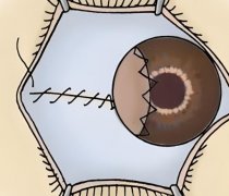 德国蔡司全飞秒机器多少钱？收费价格在15,000元左右