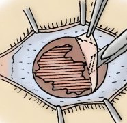 全飞秒角膜条件如何？优势，原理一起来看看吧