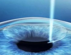 治近视眼激光手术的风险有哪些？看看风险详情和手术特点了解