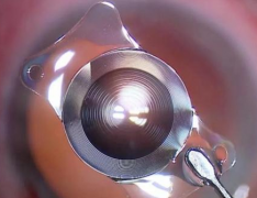 儿童的人工晶体植入术一般最早在多大进行？了解科普项目简介