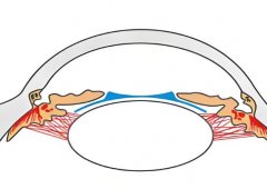 icl晶体植入的优缺点？手术多久可以用眼