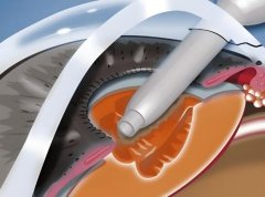 苏州远视激光矫正多少钱？费用大概是1万元起