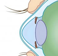 icl晶体植入价格是单眼的还是双眼的？icl晶体植入可以戴美瞳吗