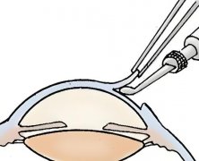 南京半飞秒手术价格一览表+医院名单出炉，2025价格更新